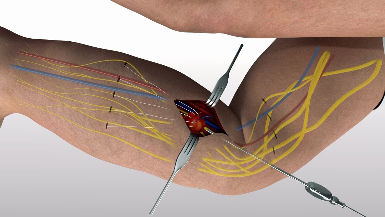Λεμφοίδημα εφαρμογή
