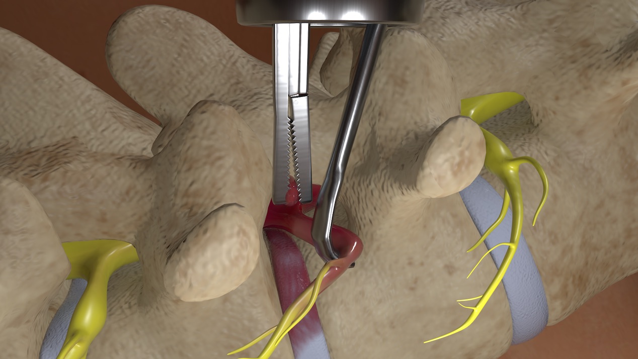 Νευροχειρουργική εφαρμογή